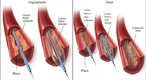 Angioplastia-coronaria.-Stents-500x274